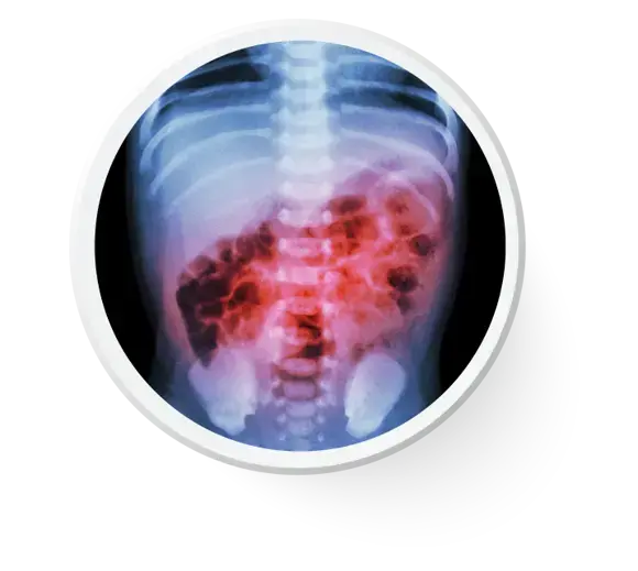 Radiografía de un niño con infección