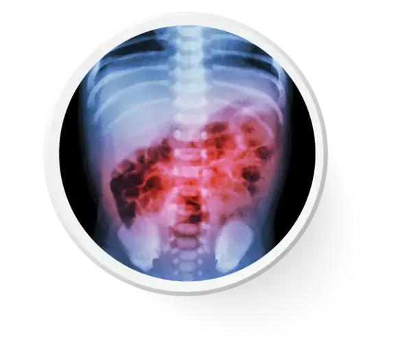Infecciones recurrentes Radiografía de un niño con infección